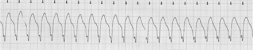 Monitorización con tres electrodos Recomendaciones 1) Monitorizar el ritmo cardiaco: 2)