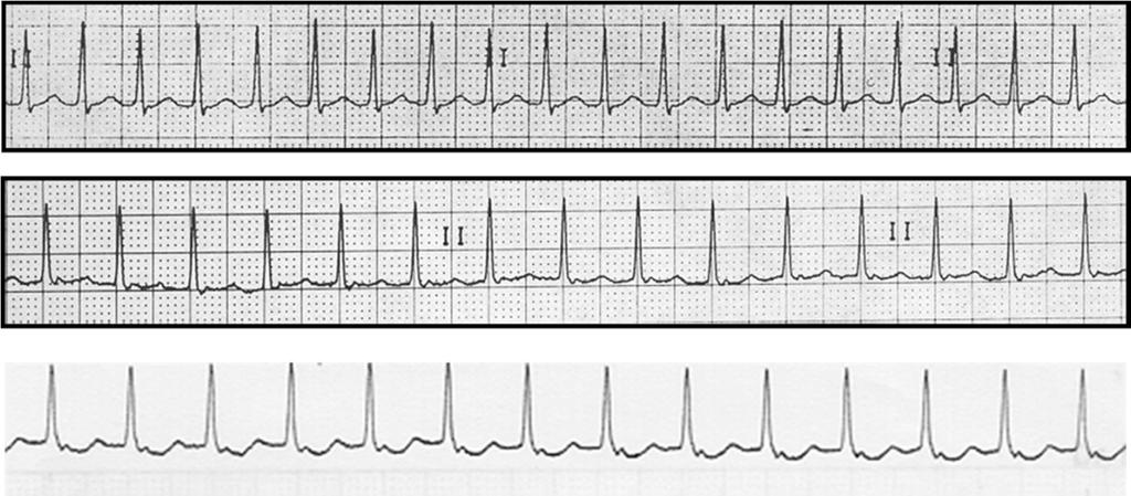 enmascarada; ocasionalmente la onda P se inscribe después del complejo QRS (en el segmento ST). Figura 20. Arriba: Taquicardia por reentrada AV. En medio y abajo: Taquicardia por reentrada intranodal.