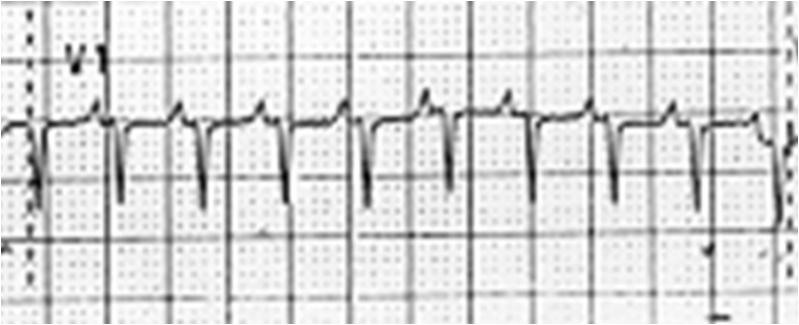 frecuencia cardiaca y al cociente de conducción, una de las ondas de flúter quedará sobrepuesta al complejo QRS (figura 22).