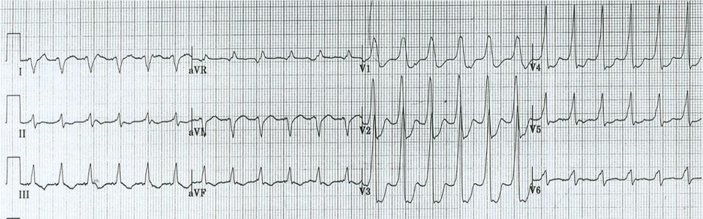 Figura 31. Taquicardia ventricular con forma de bloqueo de rama izquierda. Los complejos QRS son anchos (> 120 mseg). La frecuencia de la taquicardia es de 200 LPM aproximadamente. Figura 32.