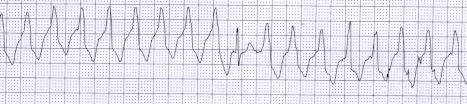 Figura 35. Latido de fusión. El ritmo es de taquicardia ventricular con una frecuencia aproximada de 115 LPM.