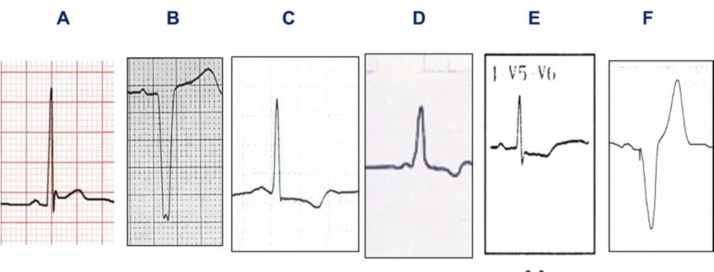 Módulo 12. Isquemia, lesión y necrosis (figura 54) La isquemia se manifiesta por una alteración en la onda T; el intervalo QTc puede estar prolongado.