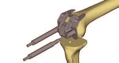 dimensión del implante tibial antero posterior y medio lateral con ayuda