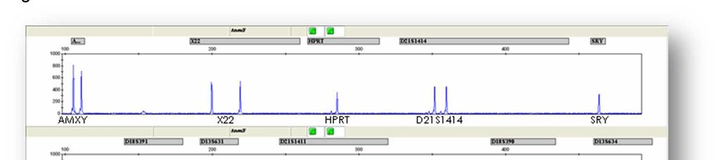 Una dotación XY (masculina) (Figura 4 13 ) estará determinada por la presencia del gen SRY, y presencia de amelogenina X e Y. Figura 4: QF-PCR XY normal.