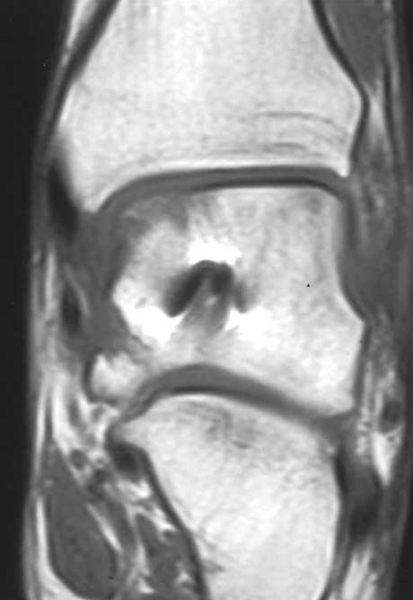 (b) Corte coronal de RMN en T1 mostrando área local de baja señal con obliteración de la cortical medial de la cúpula astragalina correspondiente al área de necrosis isquémica en la radiografía.