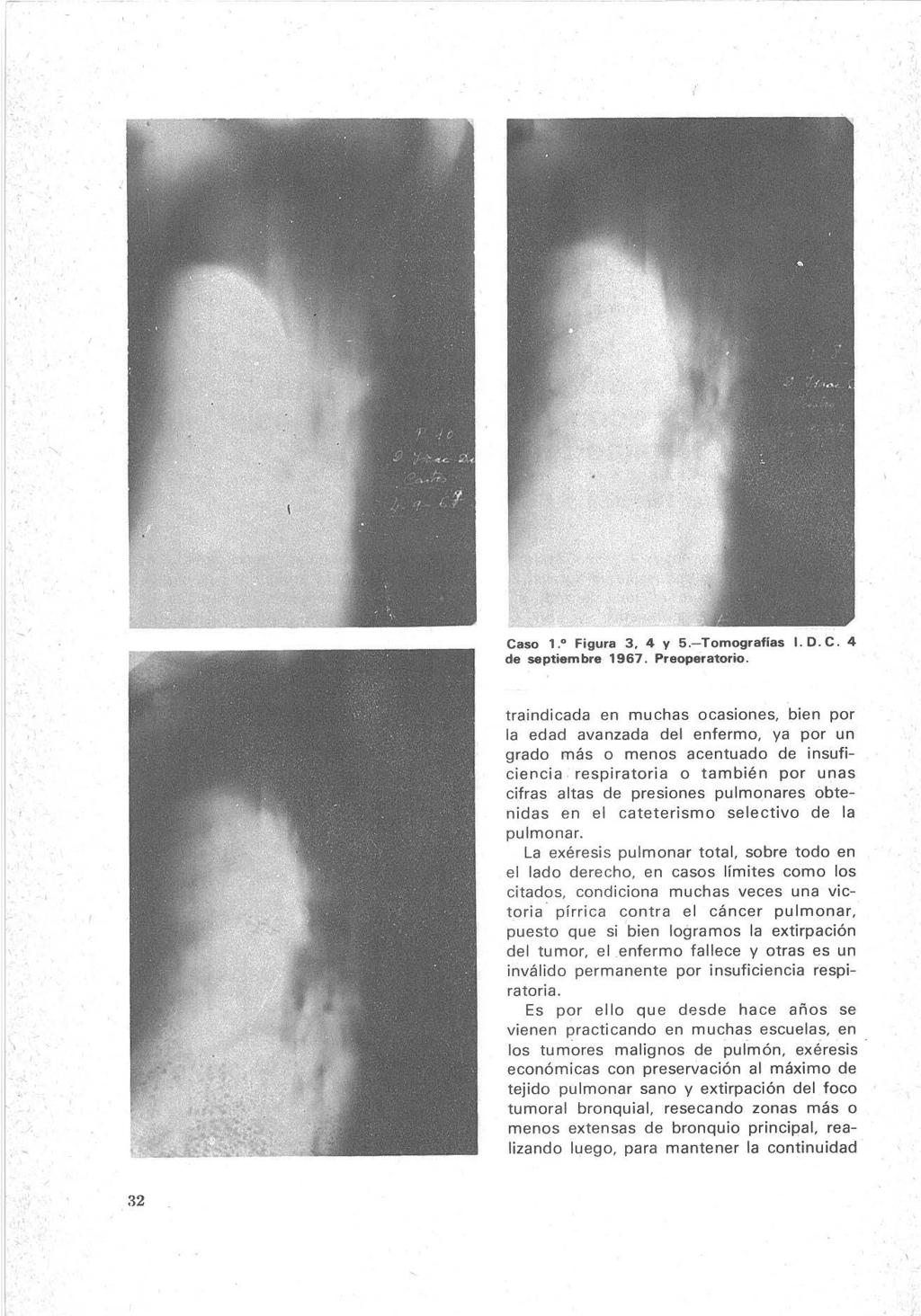 Caso 1. Figura 3, 4 y 5.-Tomograffas 1.0.C. 4 de septiembre 1967. Preoperatorio. traindicada en mu chas ocasiones, bien por la edad avanzada del enfermo.