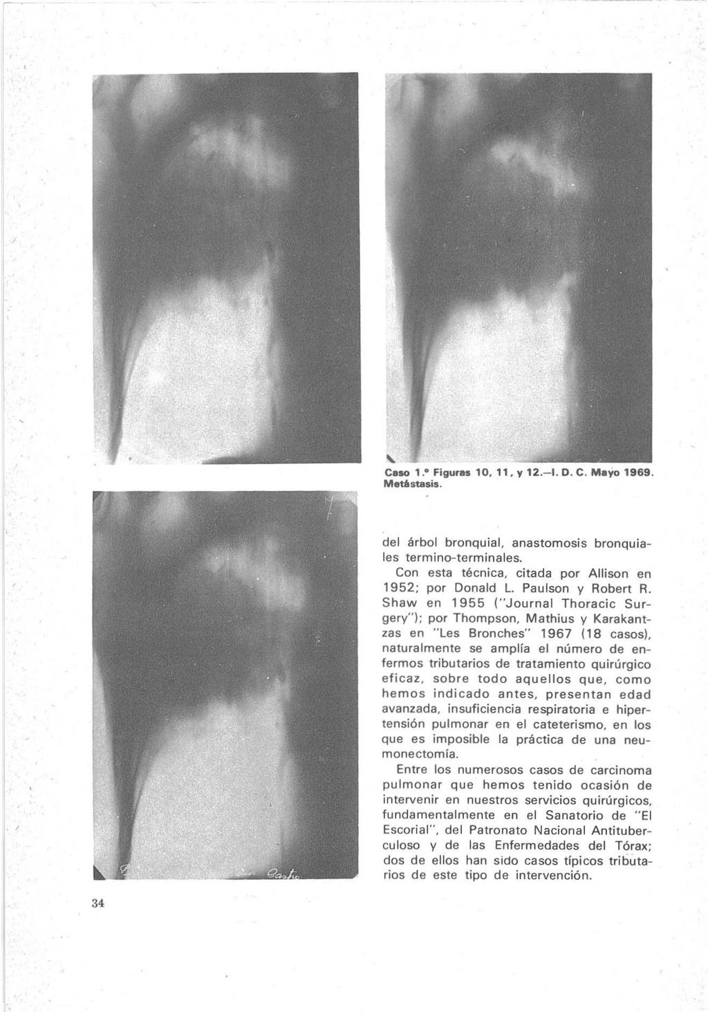 Ceso 1. Figures 10, 11. y 12.-1. D. C. Mayo 1969. Met6stasis.. I de l árbol bronquial, anastomosis bronquiales termino-term inales. Con esta técnica, citada por Allison en 1952; por Donald L.