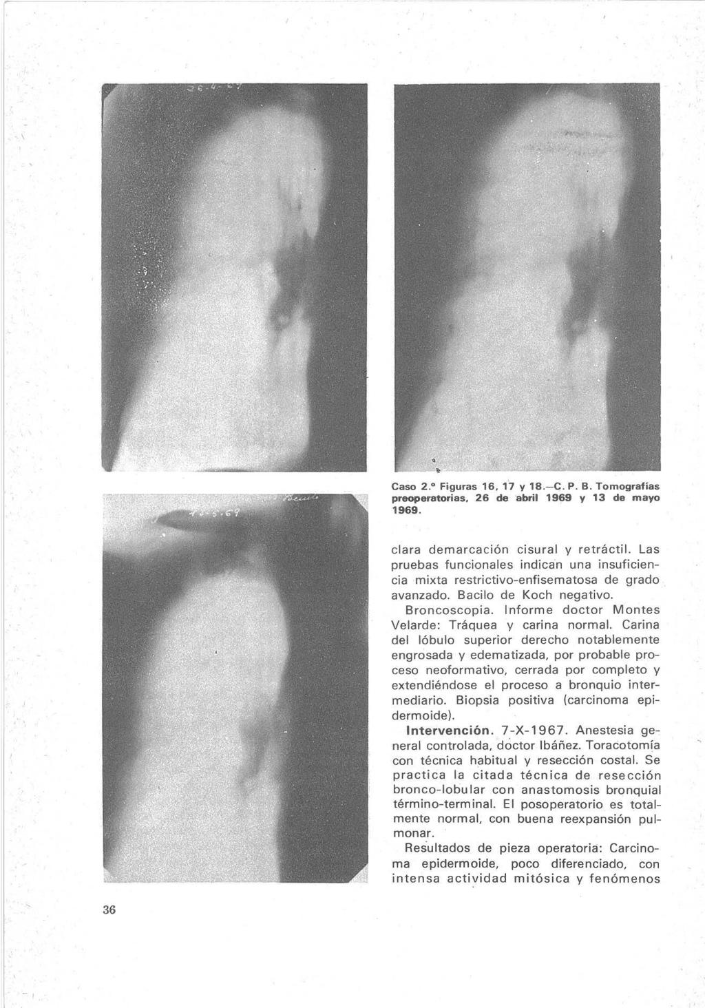 Caso 2. Figuras 16, 17 y 18.-C. P. B. Tomografías preoperatorias, 26 de abril 1969 y 13 de mayo 1969. 36 clara demarcación cisura! y retráctil.