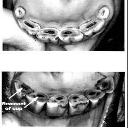DESAPARICIÓN DEL INFUNDÍBULO O CORNETE DENTARIO EXTERNO El infundíbulo está formado por la invaginación del esmalte en la tabla dentaria del incisivo.