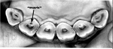 APARICIÓN DE LA ESTRELLA DENTARIA La estrella dentaria es una dentina secundaria como consecuencia del taponamiento del cornete dentario interno, y aparece como una línea amarillo-marrón entre la