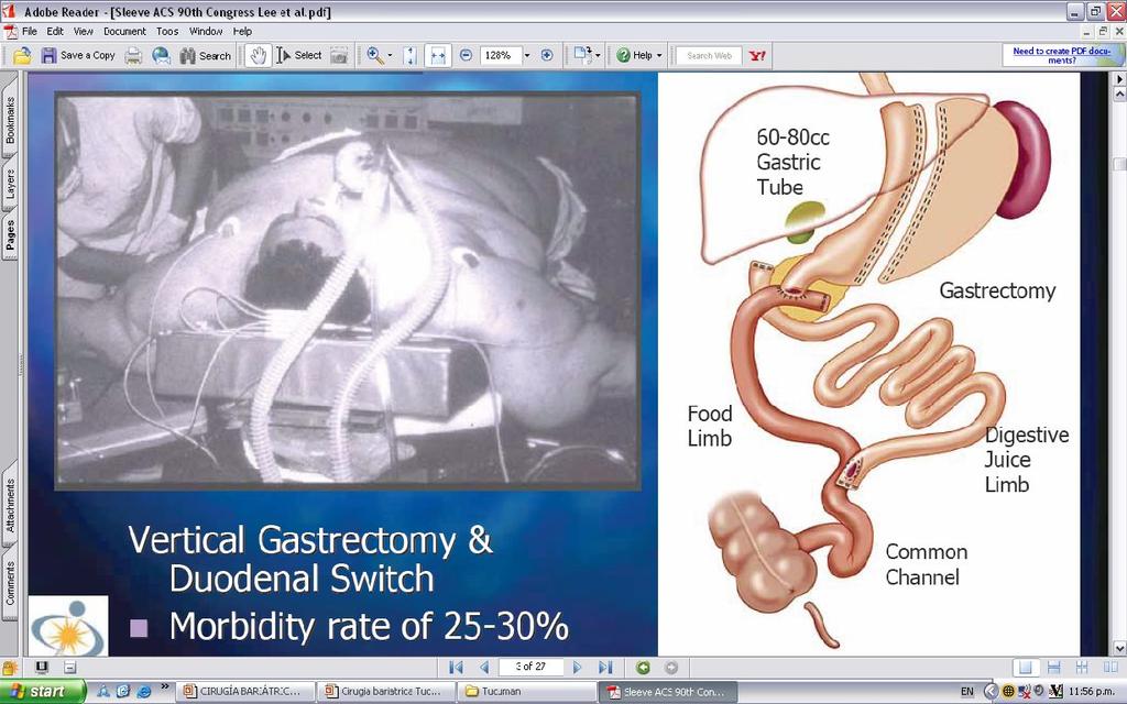 Gastrectomía en manga. Orígenes - Morbimortalidad del BPGYR y la DBP en pacientes con IMC >60 kg/m2 Mortalidad 6,25%* (3-16,7%).