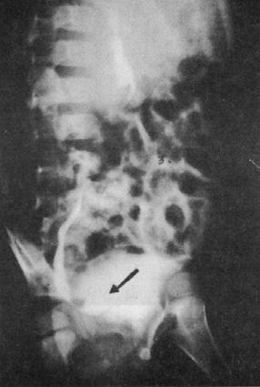 54 Figura 4. Síndrome de prune-belly. Figura 3. Ureterocele.