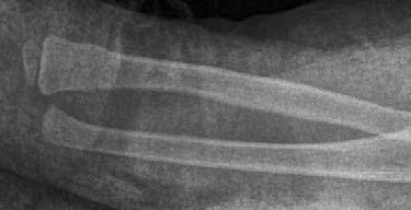 El tipo de tratamiento de la fractura del codo realizado con más frecuencia fue el quirúrgico (7 casos), aunque en 5 casos se realizó un tratamiento ortopédico con inmovilización enyesada.