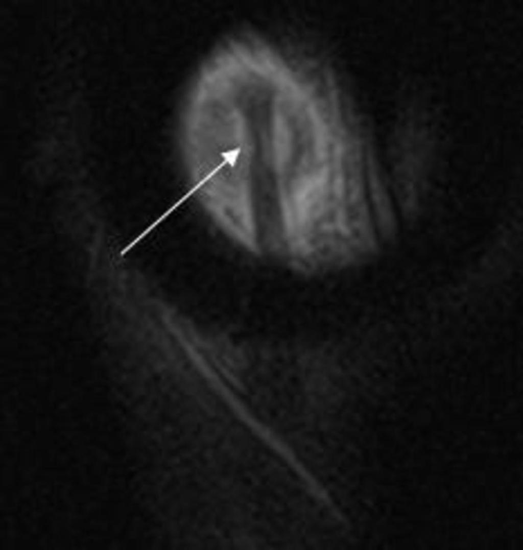 Fig. 15: FSDP coronal con antena de rodilla: adelgazamiento focal del