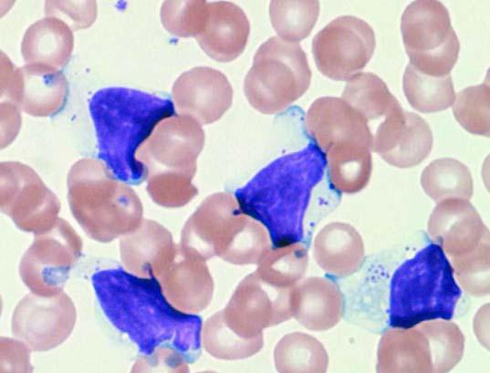 Información obtenida por el método de citometría de flujo Datos (sangre periférica) Células T Células B Granulocitos/ Células NK Monocitos CD2 99.7 CD10 1.