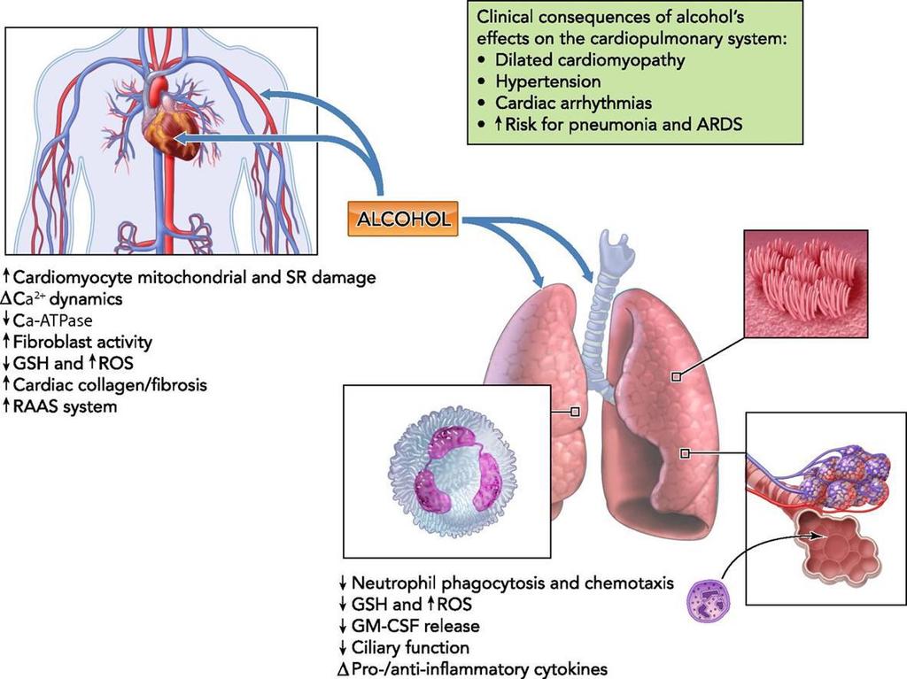 Efectos CV y respiratorios del Alcohol ARDS, acute respiratory distress syndrome; GM-CSF, granulocyte-macrophage colonystimulating factor; GSH,