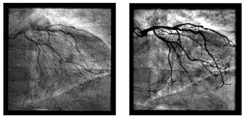 Modos de Trabajo Dos imágenes estáticas: a la izquierda una imagen obtenida con una tasa de dosis de fluoroscopia.