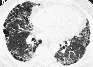 1. Fibrosis pulmonar idiopática Prevalencia