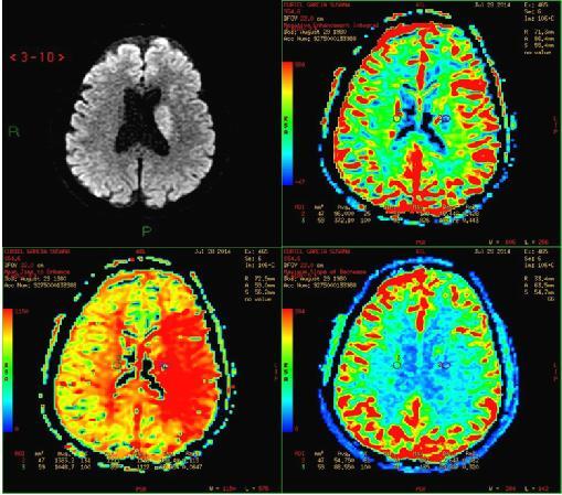 Antecedentes El volumen sanguíneo cerebral (VSC), el flujo sanguíneo cerebral (FSC) y el tiempo de transito medio
