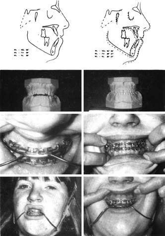 258 Rev Esp Ortod. 2011:41 Figura 6. Tratamiento de clase III presentando una mordida abierta anterior y una fuerte angulación entre el plano mandibular y la línea biespinal.