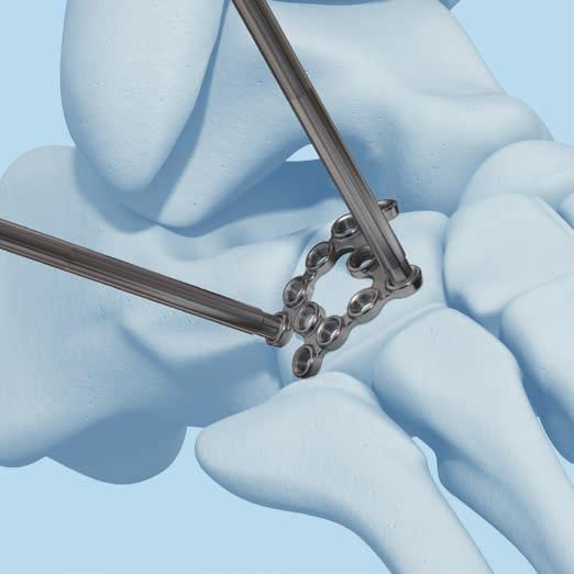 estructuras anatómicas. Uno de los principales objetivos del tratamiento de las fracturas cuboideas es el restablecimiento de la superficie articular y la longitud de la columna lateral.