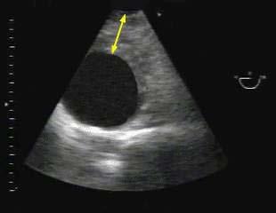 Mediante la ETE también se puede identificar la presencia de derrame pleural izquierdo localizado junto a la aorta descendente, aunque la radiografía simple de tórax puede ser suficiente para hacer