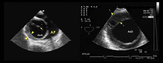 Figura 22. Izquierda. ETE. Vista transversal a 0º a nivel de la aorta ascendente donde se observa una imagen semilunar a nivel de la pared aórtica (puntas de flechas).