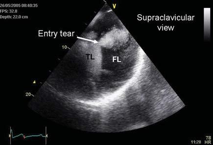 Figura 31. ETT. Vista supraesternal en un paciente con disección tipo B. La puerta de entrada está localizada en la aorta descendente proximal (flecha).