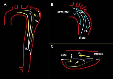 Corte longitudinal a 120º de la aorta descendente torácica proximal donde se observa que el contraste entra por la PE y llena primero la VL, luego llena la FL y vuelve en