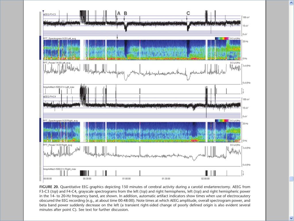 EEGc-UCI Monitoreo de EEGc en UCI Sensibilidad a eventos isquemicos Endarterectomia carotidea A = pinzamiento de