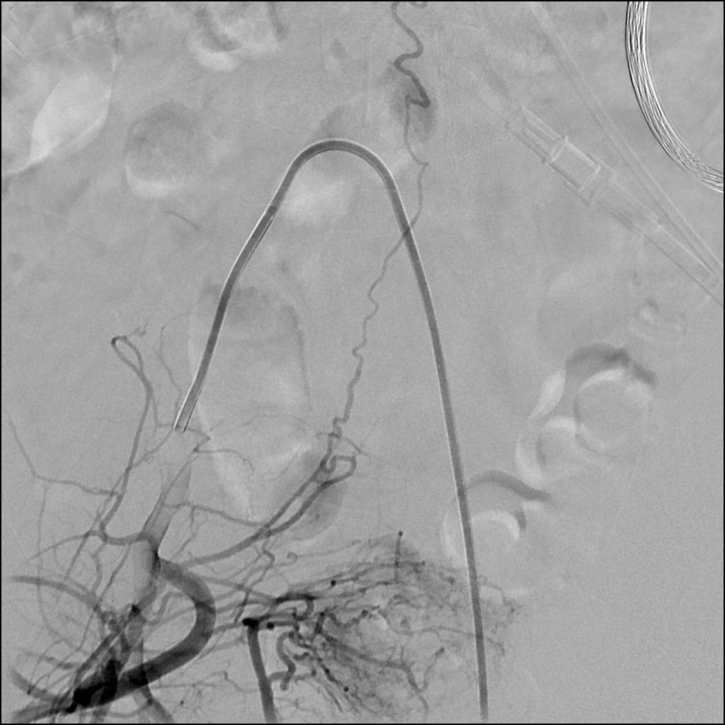 Fig. 3: Arteriografía selectiva ilíaca que muestra shunt arteriovenoso dural con aferencia desde arteria