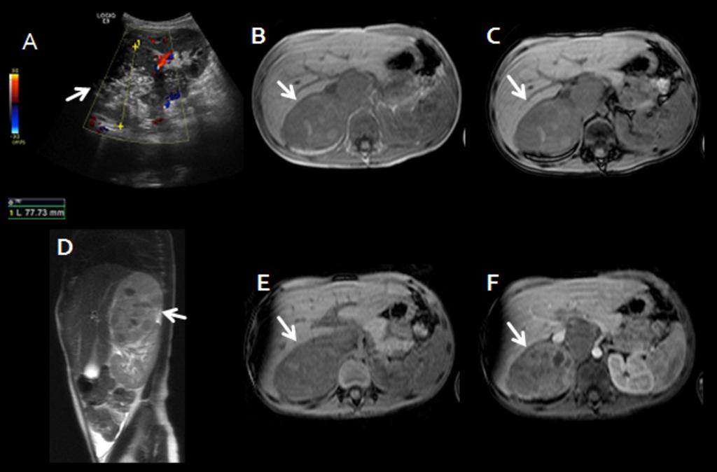 Fig. 13: Neuroblastoma en niño de 6 años.(a)ecografia de masa suprarrenal derecha de contornos irregulares y heterogénea, con áreas hiperecogénicas en relación con calcificaciones.