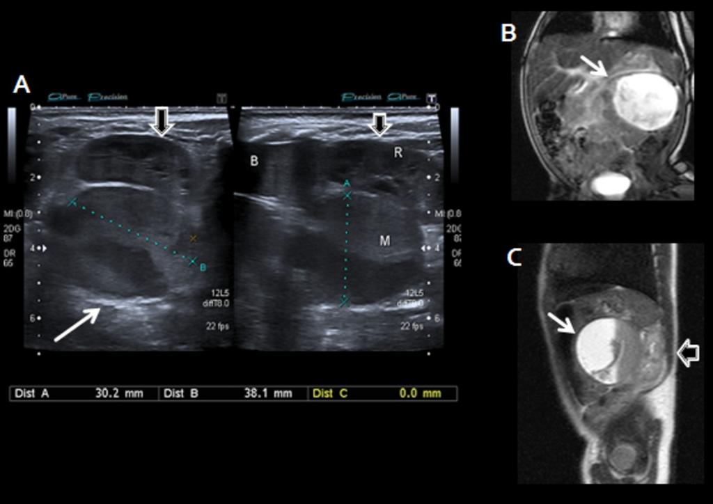 Fig. 14: Neuroblastoma quístico en recién nacido de 8 dias de edad. Masa quística compleja suprarrenal derecha en ecografía (Flecha fina) que desplaza al riñón (Flecha gruesa) (A).
