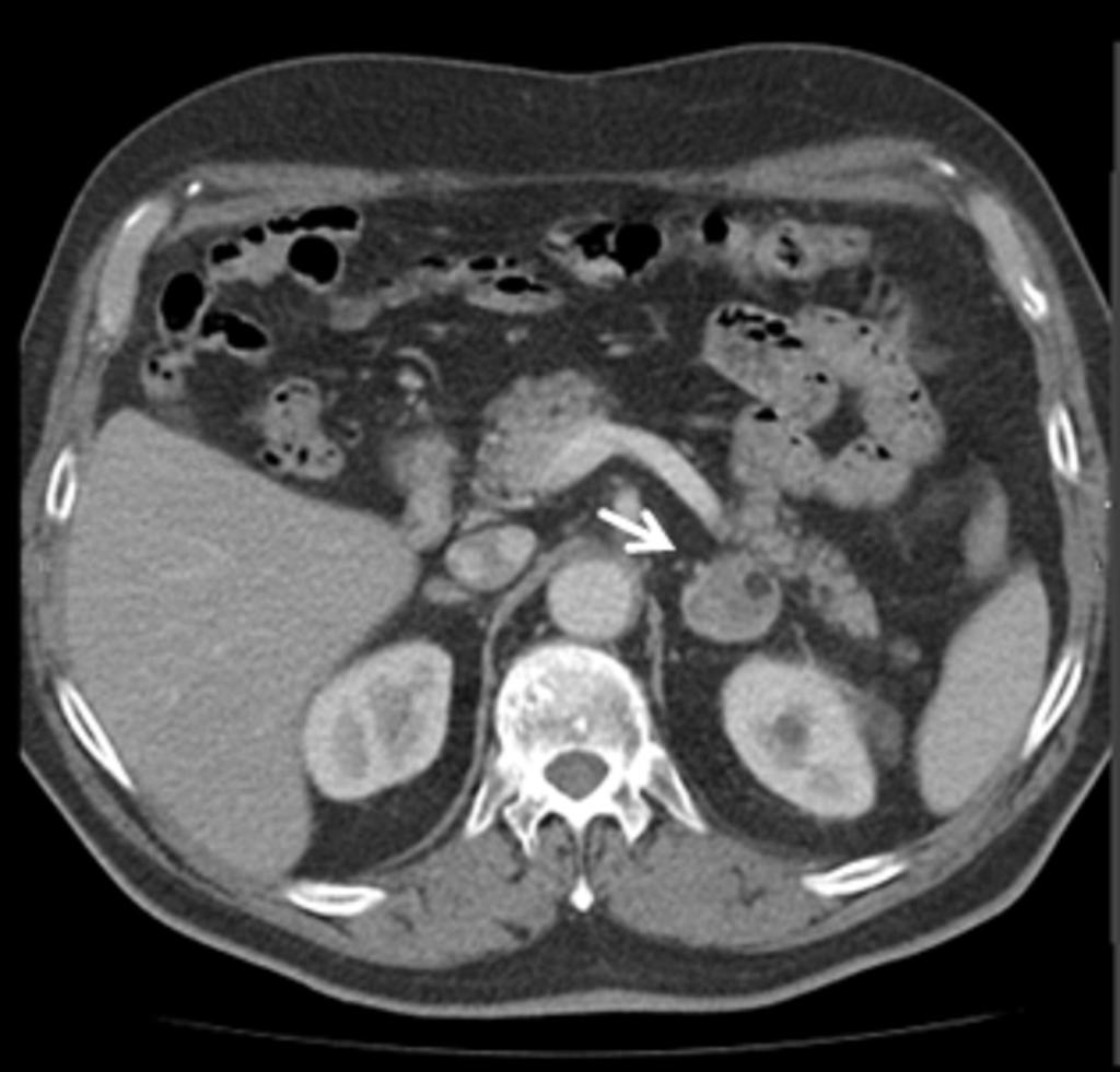 Fig. 3: Mielolipoma adrenal izquierdo en TC abdominal con contraste.