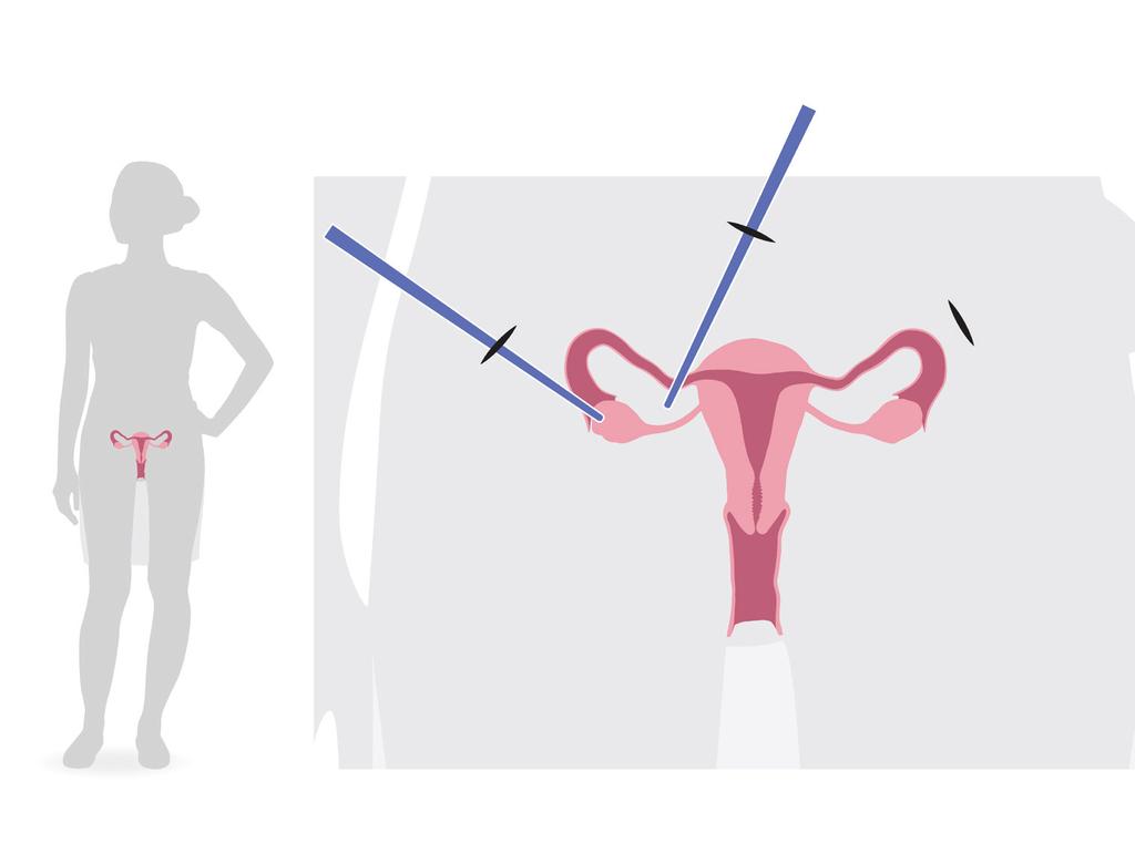 Laparoscopia Incisión Ovario Útero Cómo se extrae un trozo del ovario? Estarás anestesiada y, por tanto, no sentirás nada.