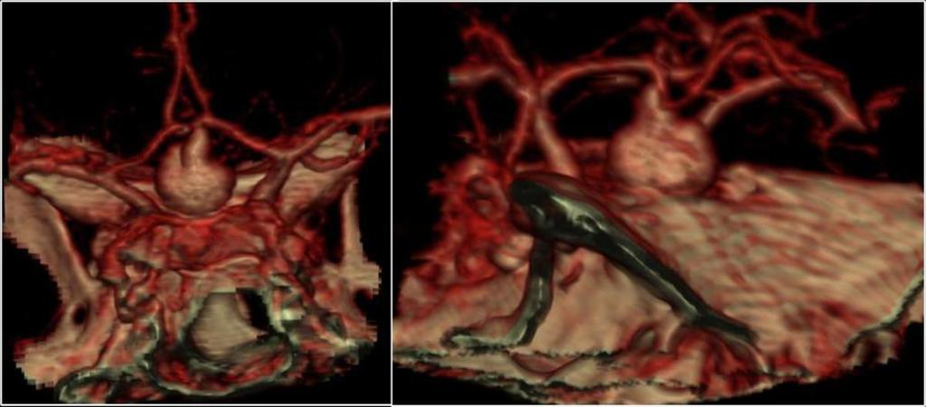 Fig. 6: Angio-Tc, reconstrucciones en 3D: Imagen de adición de contraste de morfología sacular en región de
