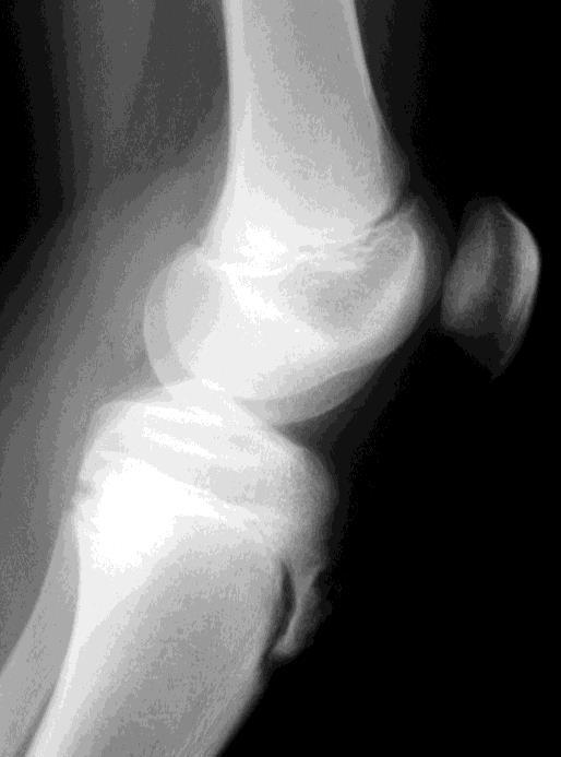 En general se recomienda empezar el estudio de imagen por una radiografía anteroposterior y perfil de rodilla.