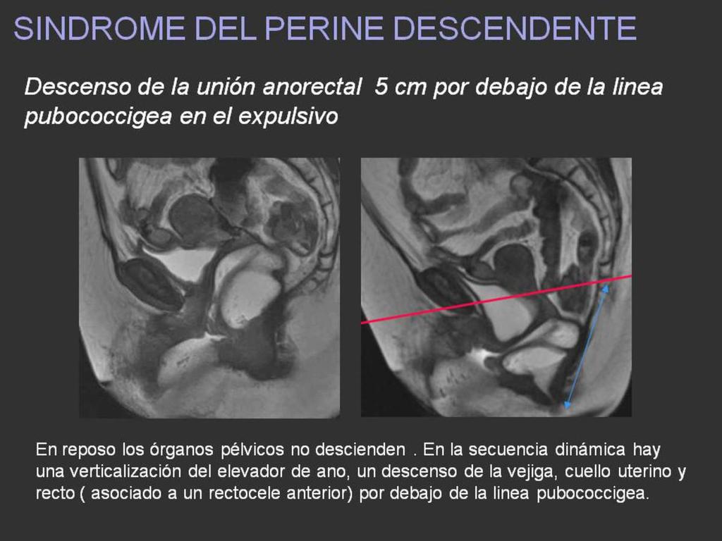 Fig. 22: Descenso de la unión anorectal 5 cm por debajo de la linea pubococcigea en el expulsivo En reposo los órganos pélvicos no descienden.