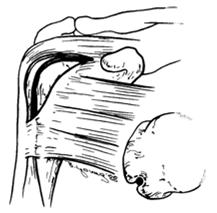 Clasificación de las lesiones bicipitales Tipo C: Atrición primaria Lesiones primarias que surgen dentro de la corredera Dolor y degeneración del tendón Formación de