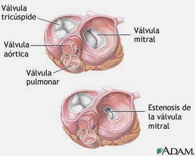 Estenosis Mitral Impide el flujo sanguíneo adecuado entre la aurícula izquierda (cámara superior) y el ventrículo izquierdo (cámara inferior).