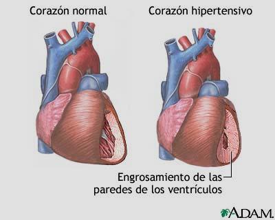 CARDIOMIOPATIA HIPERTENSIVA Es una complicación tardía de la hipertensión (presión sanguínea alta).