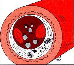 ARTERIOESCLEROSIS/ATEROESCLEROSIS Endurecimiento de las arterias; Acumulación de placa en las arterias.