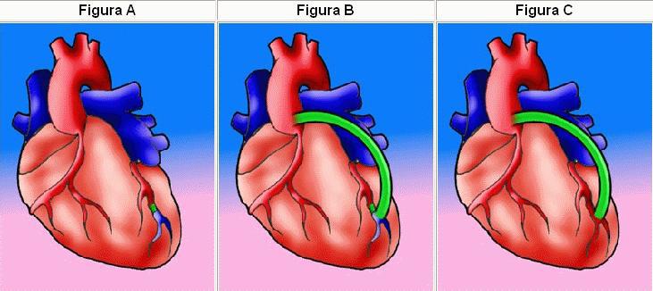 Cirugía: Bypass coronario permite mejorar el flujo sanguíneo al corazón creando