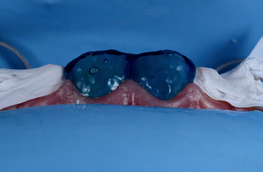TERCER DÍA PROGRAMA TEÓRICO Carillas e incrustaciones: Revisión de los biomateriales actuales y sus indicaciones clínicas. Principios y Fundamentos en Adhesión a tejidos dentarios.