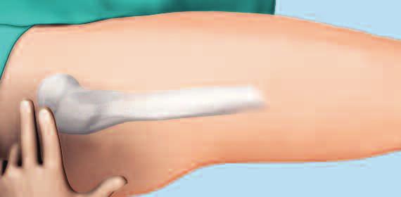 4 Acceso Efectúe una incisión cutánea lateral recta de 15 cm de longitud, comenzando a una distancia de dos dedos en sentido proximal con respecto a la punta del trocánter mayor.
