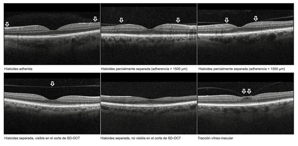 Oftalmología Clínica y Experimental Volumen 10 Número 2 Junio 2017 ran obtenerse imágenes definidas de la interfase vitreorretinal.