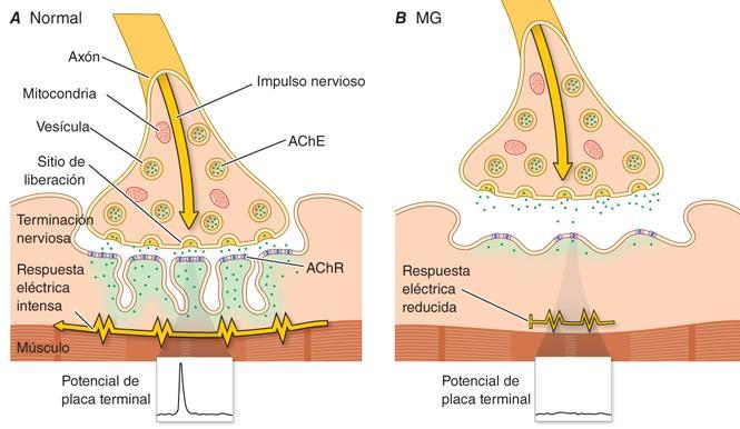 MIASTENIA GRAVE Concepto La miastenia grave (MG) es una enfermedad de la unión neuromuscular (tabla 1) de naturaleza autoinmune cuyo mecanismo patogénico está mediado por anticuerpos frente a