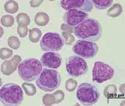 Enfoque diagnóstico de las leucemias mieloides agudas pediátricas Figura 7. Características morfológicas de la leucemia mieloide aguda con t(9;11)(p22;q23); MLLT3-KM- T2A.