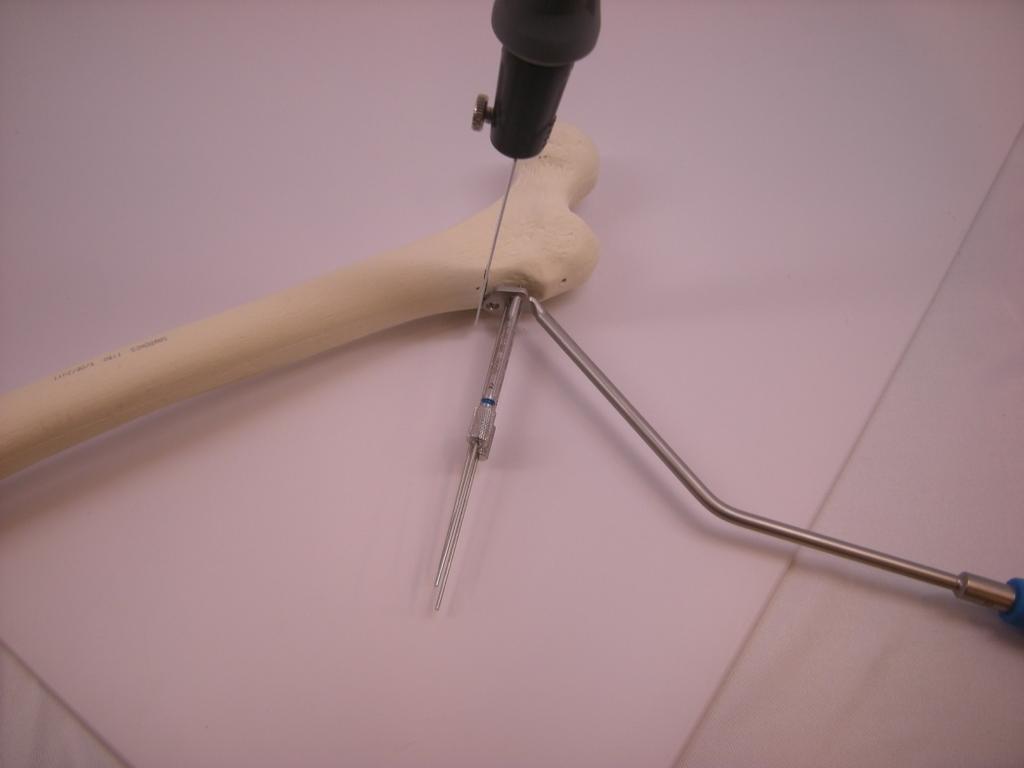 Usando la guía de aguja para osteotomía coloque la hoja de la sierra oscilante contra el borde