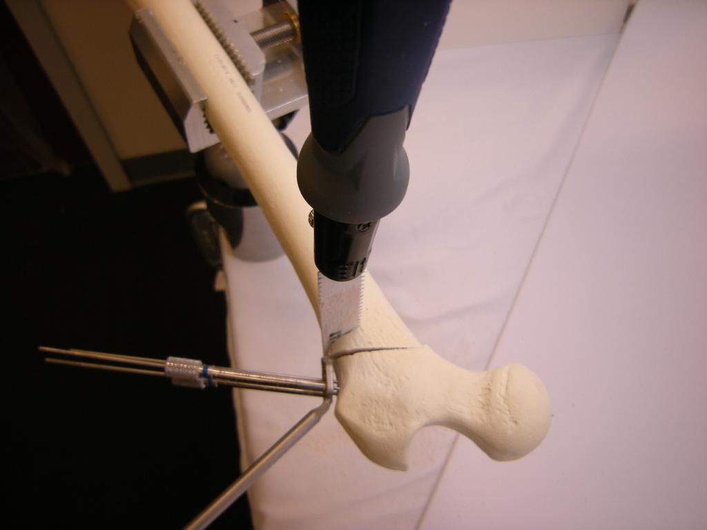 Usando la guía de aguja para osteotomía como mango, mantenga control del fragmento proximal